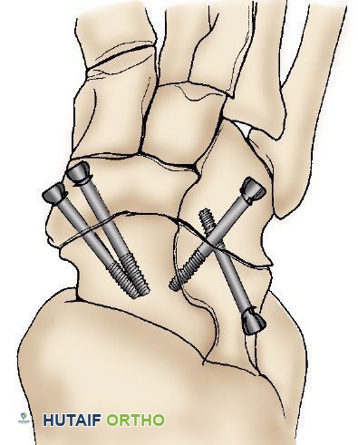 صورة طبية: التهاب مفاصل القدم والكاحل: دليل شامل للتشخيص والعلاج مع الأستاذ الدكتور محمد هطيف