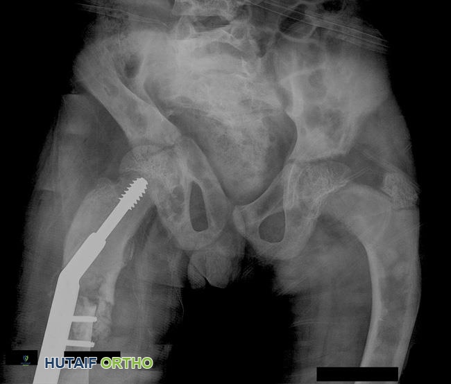 تثبيت داخلي لكسر مرضي