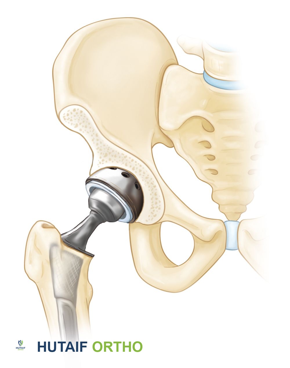 صورة توضيحية لـ النخر العظمي في مفصل الورك: دليل شامل للمرضى مع الأستاذ الدكتور محمد هطيف