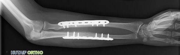 صورة توضيحية لـ كسور الساعد لدى البالغين الأسباب الأعراض العلاج والتعافي في صنعاء مع الأستاذ الدكتور محمد هطيف
