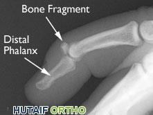 إصابة قلعية