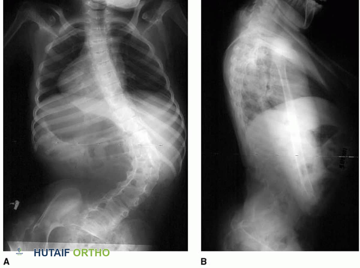 صورة توضيحية لـ الجنف العصبي العضلي عند الأطفال: دليل شامل من الأستاذ الدكتور محمد هطيف