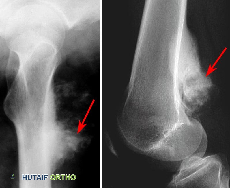 صور أشعة سينية لنوعين فرعيين من ساركوما العظام: حول السمحاق والسمحاقي