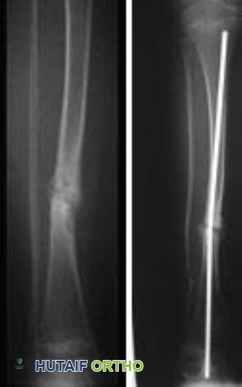 صورة توضيحية لـ الورم الليفي العصبي: دليل شامل للمرضى والعائلات مع الأستاذ الدكتور محمد هطيف