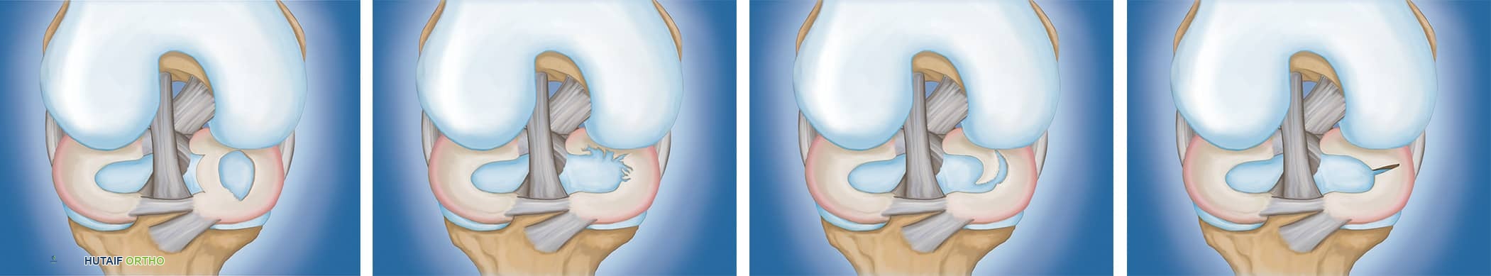 أنواع تمزقات الغضروف الهلالي