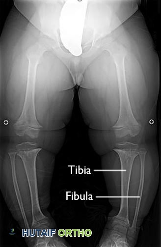 صورة طبية: الودانة (التقزم الغضروفي): دليل شامل للمرضى مع الأستاذ الدكتور محمد هطيف