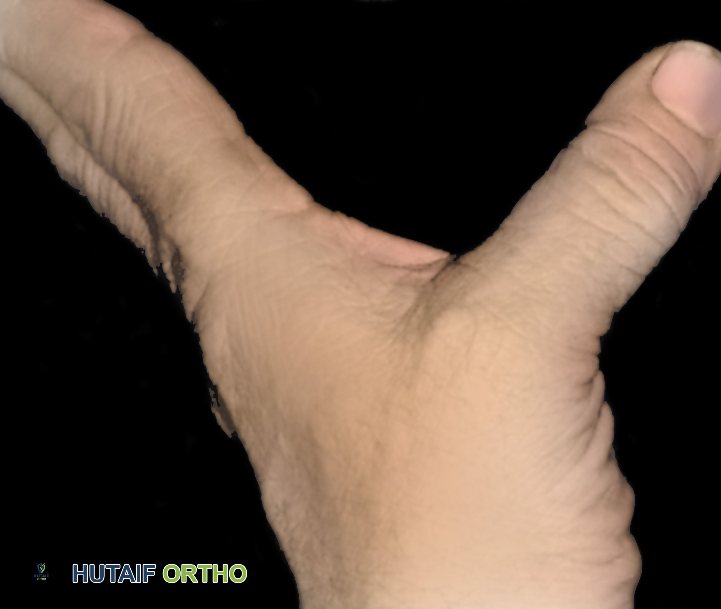 صورة توضيحية لـ التواء إبهام اليد: دليل شامل للتشخيص والعلاج مع الأستاذ الدكتور محمد هطيف في صنعاء