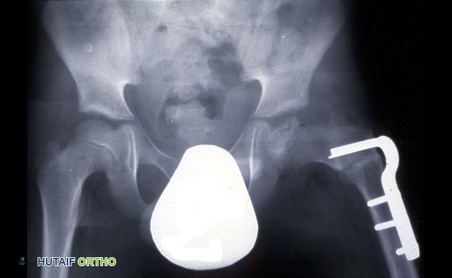 صورة طبية: مرض بيرثيز عند الأطفال: دليل شامل للآباء والعلاج المتطور في صنعاء مع الأستاذ الدكتور محمد هطيف