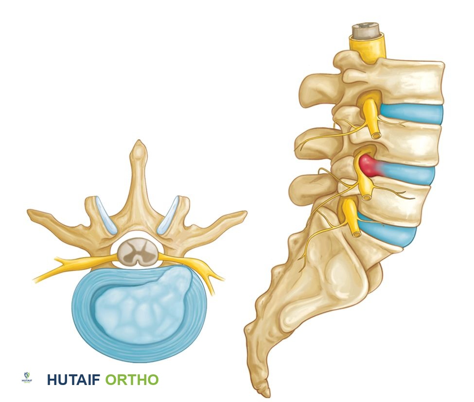 قرص منزلق يضغط على العصب