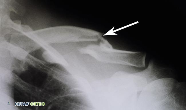 صورة توضيحية لـ كسر الترقوة (عظم الترقوة المكسور): دليل شامل للمرضى مع الأستاذ الدكتور محمد هطيف