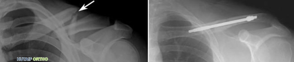 صورة توضيحية لـ كسر الترقوة (عظم الترقوة المكسور): دليل شامل للمرضى مع الأستاذ الدكتور محمد هطيف