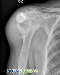 صورة توضيحية لـ ورم الغضروف الخبيث (Chondrosarcoma): دليل شامل للمرضى مع الأستاذ الدكتور محمد هطيف