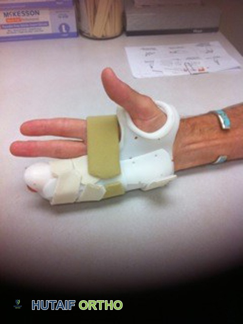 صورة توضيحية لـ مرض دوبويتران: دليل شامل للتشخيص والعلاج مع الأستاذ الدكتور محمد هطيف في صنعاء