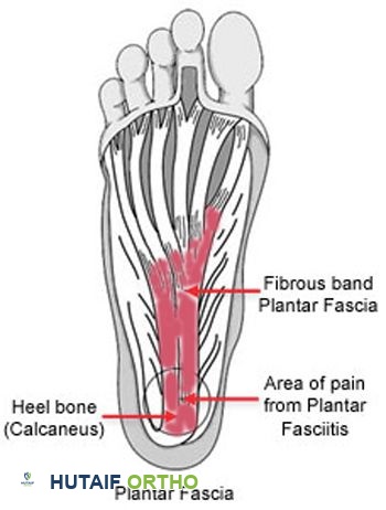 اللفافة الأخمصية