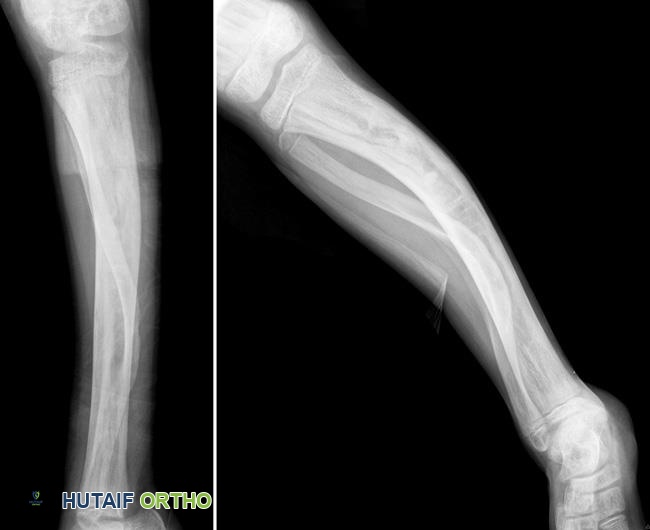 تقوس الساق بسبب خلل التنسج الليفي
