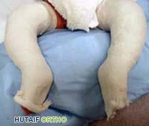 طريقة بونستي لعلاج القدم الحنفاء