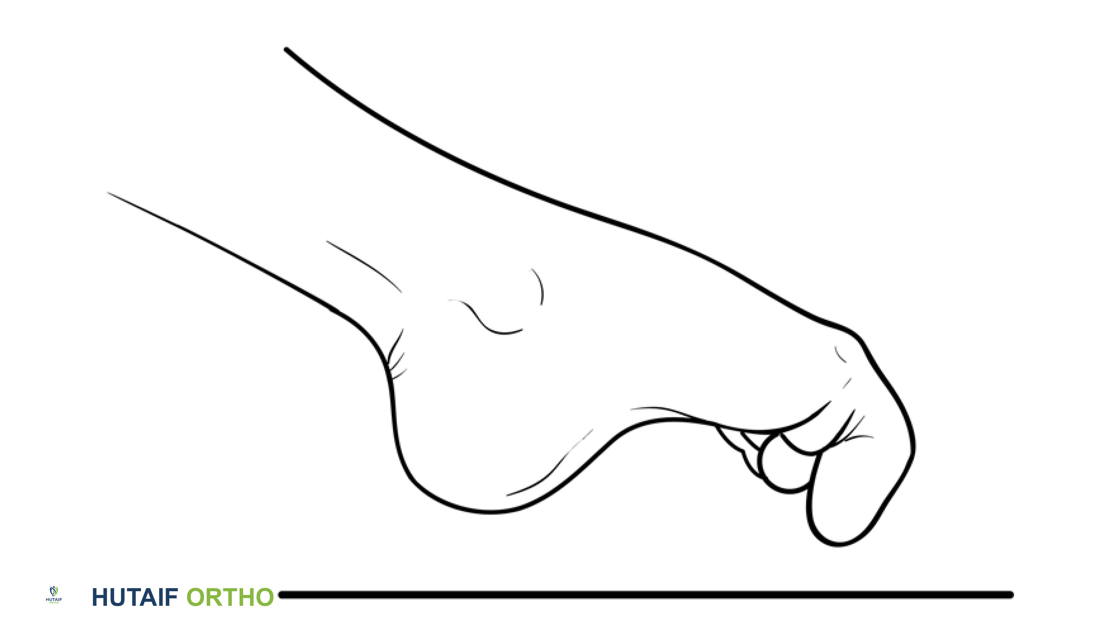 صورة طبية: برنامج شامل لتقوية وتأهيل القدم والكاحل: دليلك للتعافي في صنعاء مع الأستاذ الدكتور محمد هطيف