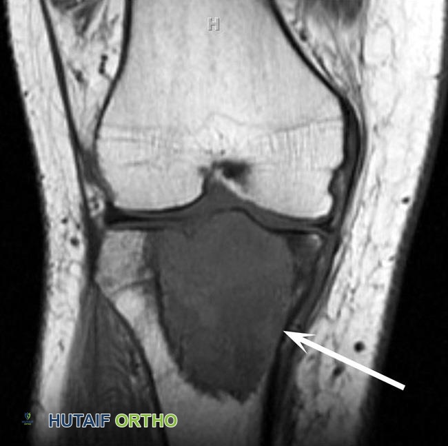 توضيح طبي: ورم الخلايا العملاقة في العظم: دليل شامل للمرضى مع الأستاذ الدكتور محمد هطيف