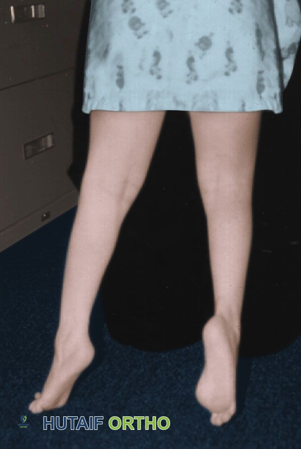 صورة توضيحية لـ المشي على رؤوس الأصابع عند الأطفال: دليل شامل للآباء مع الأستاذ الدكتور محمد هطيف في صنعاء