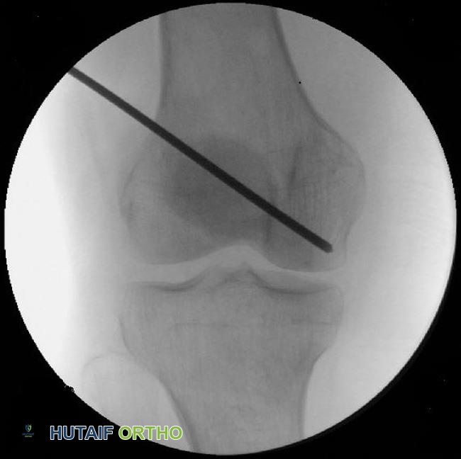 صورة طبية: نخر عظم الركبة: دليل شامل للمرضى مع الأستاذ الدكتور محمد هطيف في صنعاء