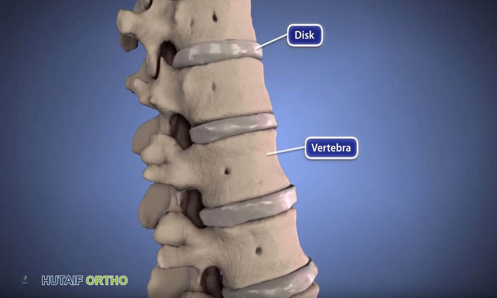 توضيح آخر يوضح آلية الانزلاق الغضروفي وانضغاط جذر العصب.