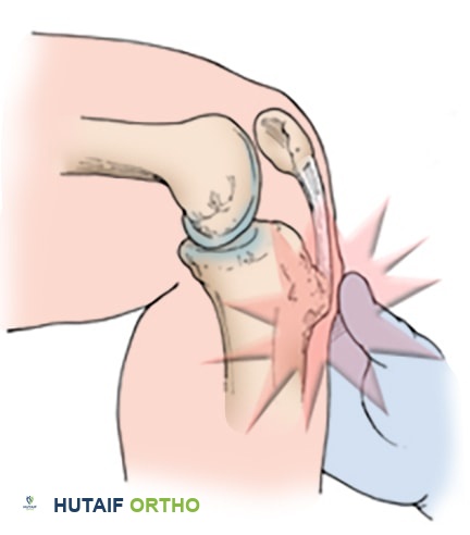 صورة توضيحية لـ مرض أوزغود شلاتر: دليل شامل لآلام الركبة عند المراهقين والعلاج الفعال مع الأستاذ الدكتور محمد هطيف في صنعاء