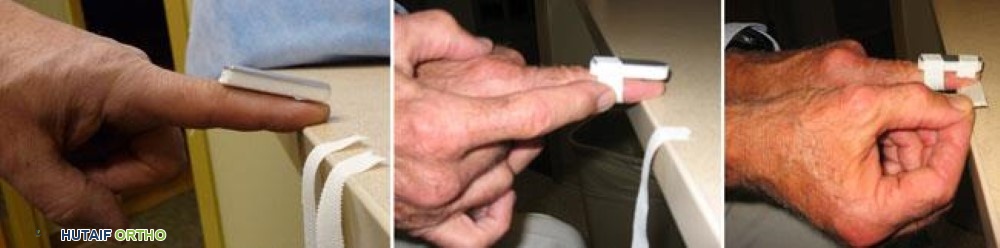 تطبيق جبيرة إصبع مؤقتة