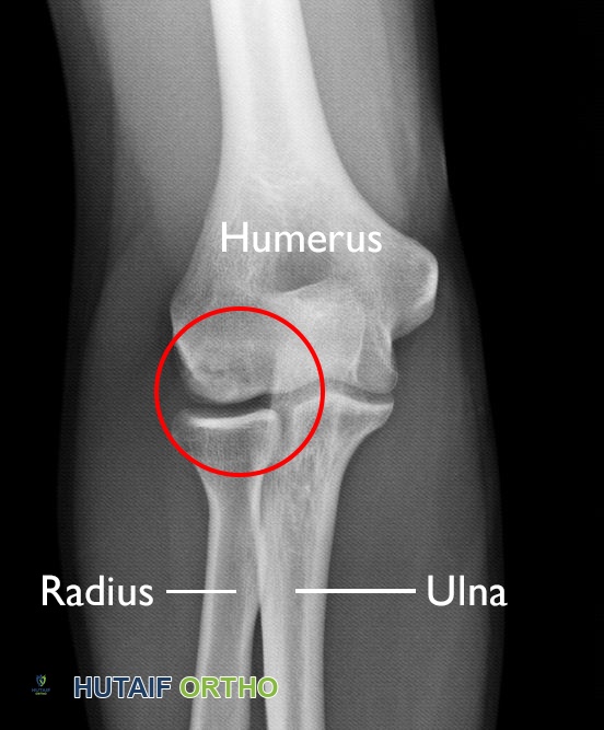 آفة التهاب العظم والغضروف السالخ في المرفق
