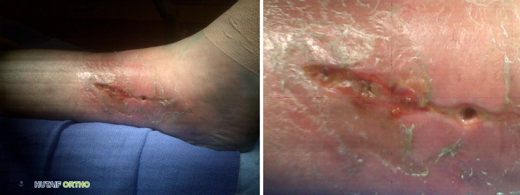 صورة توضيحية لـ التهابات ما بعد الكسور: دليل شامل للمرضى في اليمن مع الأستاذ الدكتور محمد هطيف