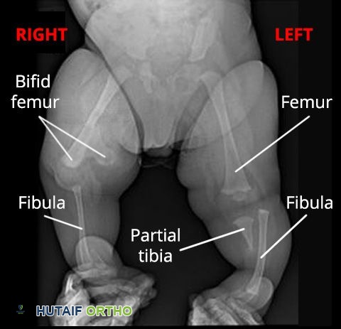 X-ray of tibial hemimelia