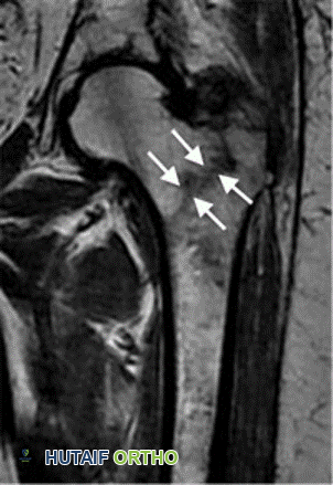 صورة توضيحية لـ كسور الورك: دليل الأستاذ الدكتور محمد هطيف الشامل للتشخيص والعلاج في صنعاء