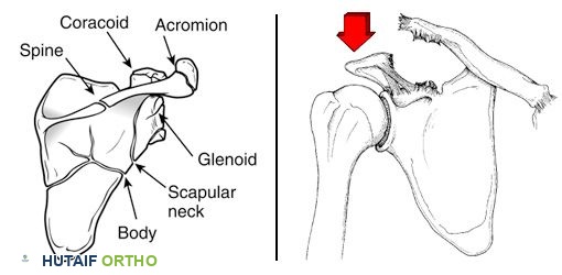 رسوم توضيحية لأنماط الكسور في لوح الكتف وخلع المفصل الأخرمي الترقوي