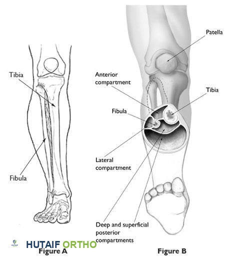 متلازمة الحيز: دليل شامل للمرضى مع الأستاذ الدكتور محمد هطيف في صنعاء