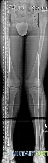 صورة توضيحية لـ تفاوت طول الأطراف السفلية الأسباب الأعراض وخيارات العلاج المتقدمة مع الأستاذ الدكتور محمد هطيف