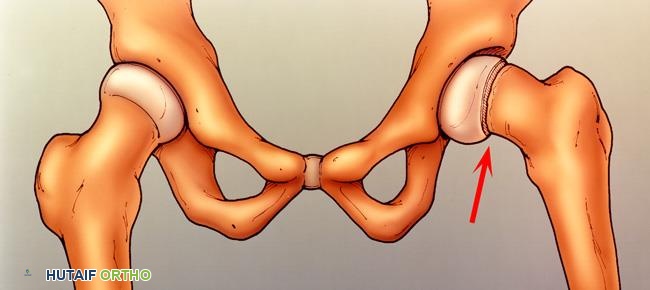 صورة توضيحية لـ سمنة الأطفال وتأثيرها على العظام والمفاصل: دليل شامل من الأستاذ الدكتور محمد هطيف