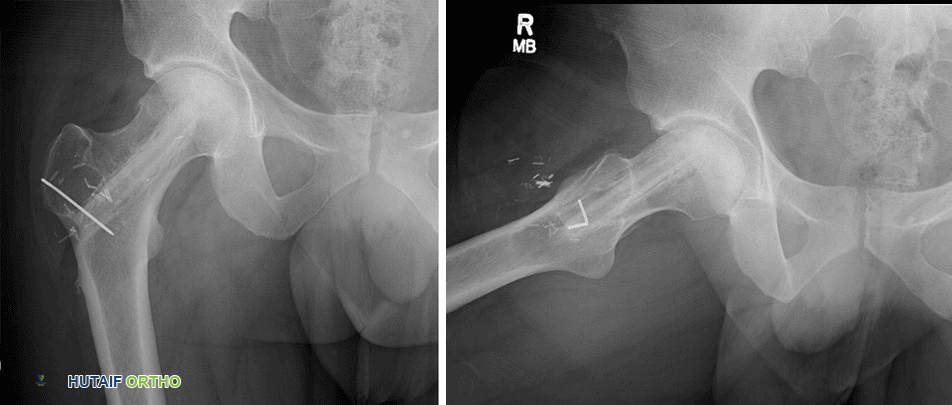 صورة توضيحية لـ النخر العظمي في مفصل الورك: دليل شامل للمرضى مع الأستاذ الدكتور محمد هطيف