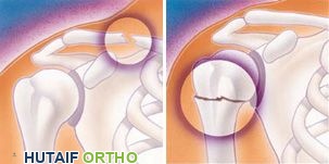 رسوم توضيحية لكسر الترقوة وكسر الجزء العلوي من عظم العضد