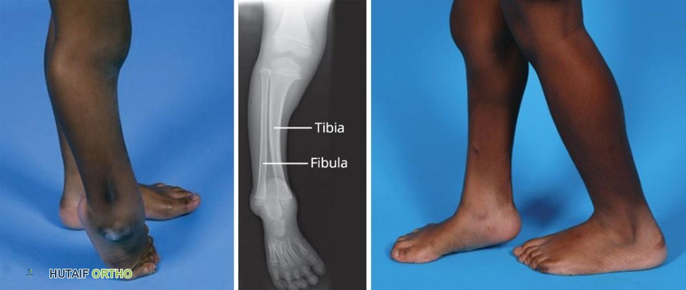 Limb reconstruction results