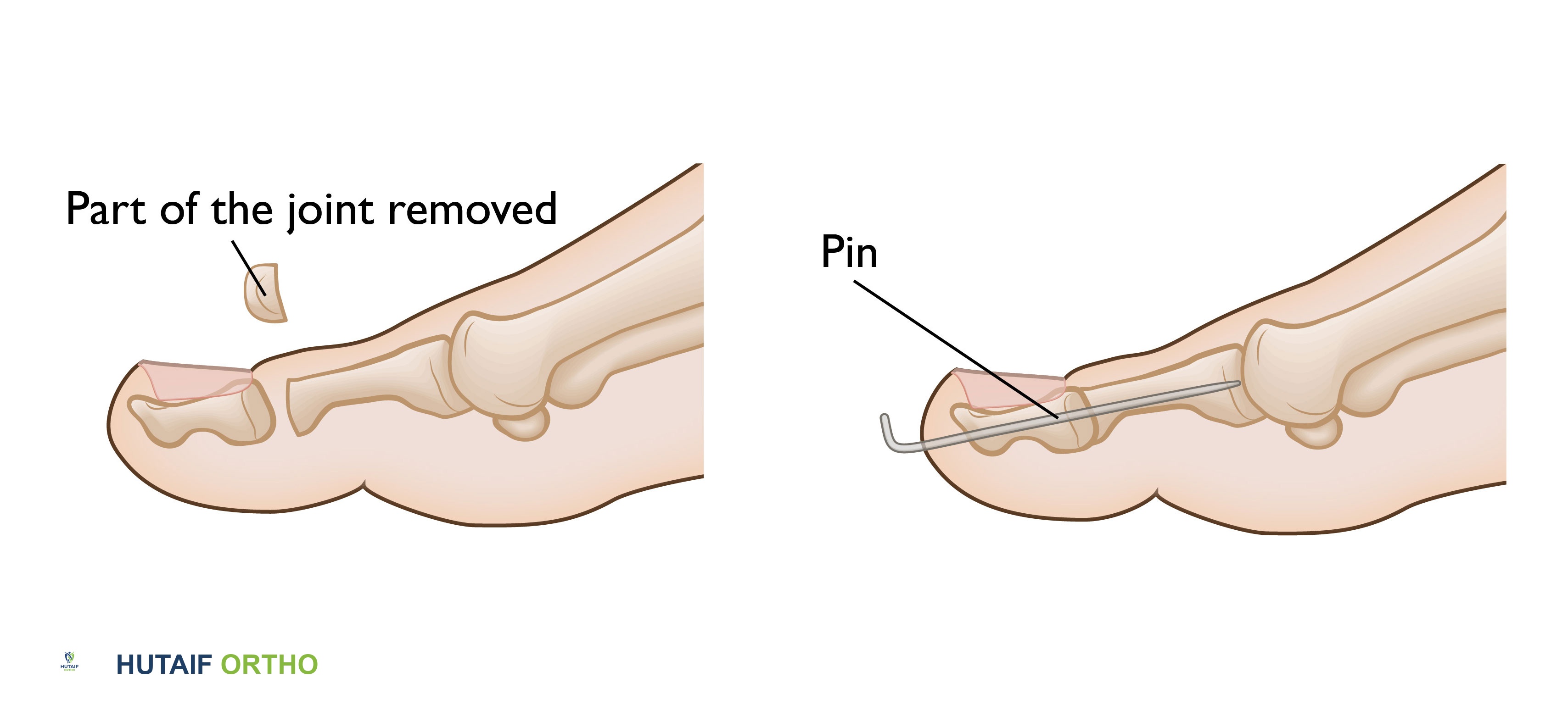 صورة توضيحية لـ إصبع القدم المخلبي: دليل شامل من الأسباب إلى العلاج مع الأستاذ الدكتور محمد هطيف