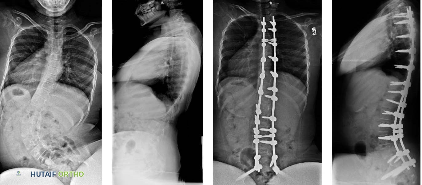 صورة طبية: الجنف العصبي العضلي عند الأطفال: دليل شامل من الأستاذ الدكتور محمد هطيف