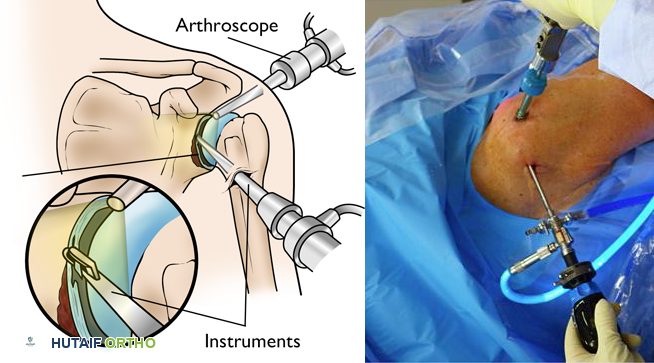 جراحة تنظير المفصل