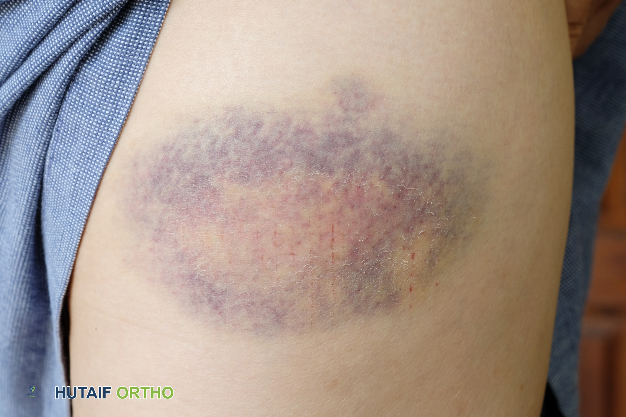 صورة توضيحية لـ كدمة العضلات (الرضوض العضلية): دليل شامل للعلاج والتعافي مع الأستاذ الدكتور محمد هطيف في صنعاء