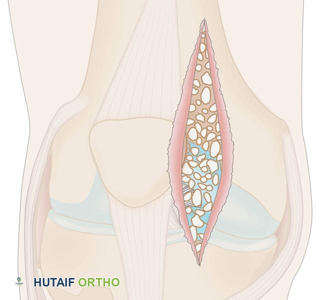 رسم توضيحي لإجراء جراحي مفتوح لإزالة الأجسام الحرة