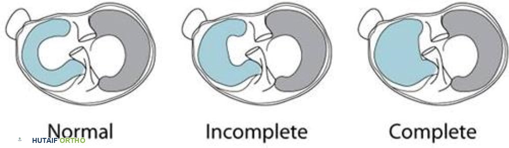 صورة توضيحية لـ الغضروف الهلالي القرصي: دليل شامل للمرضى في اليمن مع الأستاذ الدكتور محمد هطيف