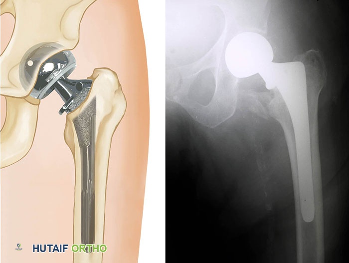 صورة طبية: كسور الورك: دليل الأستاذ الدكتور محمد هطيف الشامل للتشخيص والعلاج في صنعاء