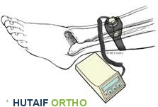 جهاز تحفيز العظم الخارجي