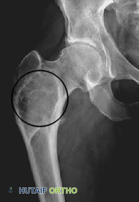 مظهر الزجاج المصنفر في الأشعة السينية