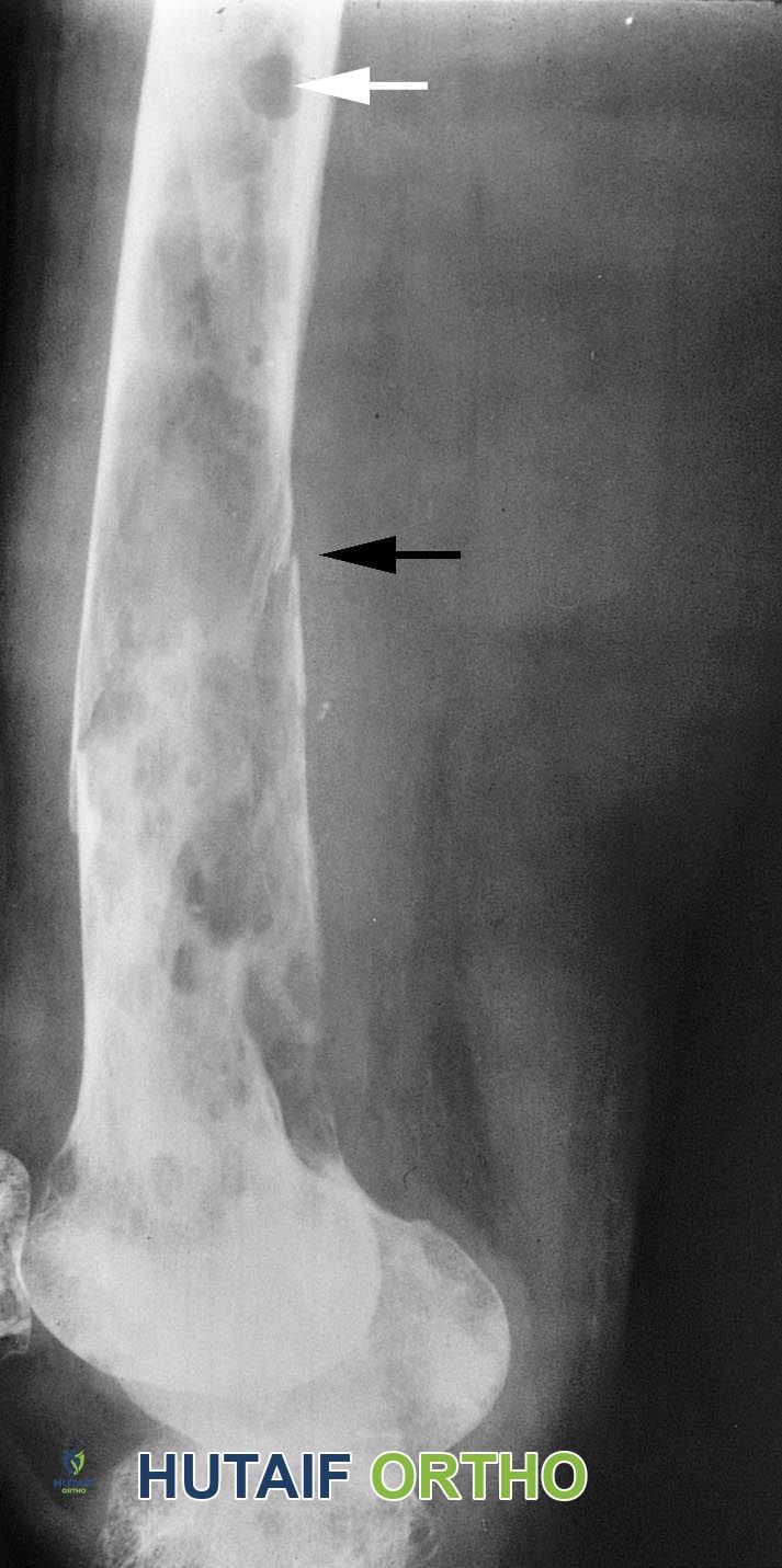 صورة توضيحية لـ الورم النقوي المتعدد والبلازماوي: دليل شامل للمرضى مع الأستاذ الدكتور محمد هطيف