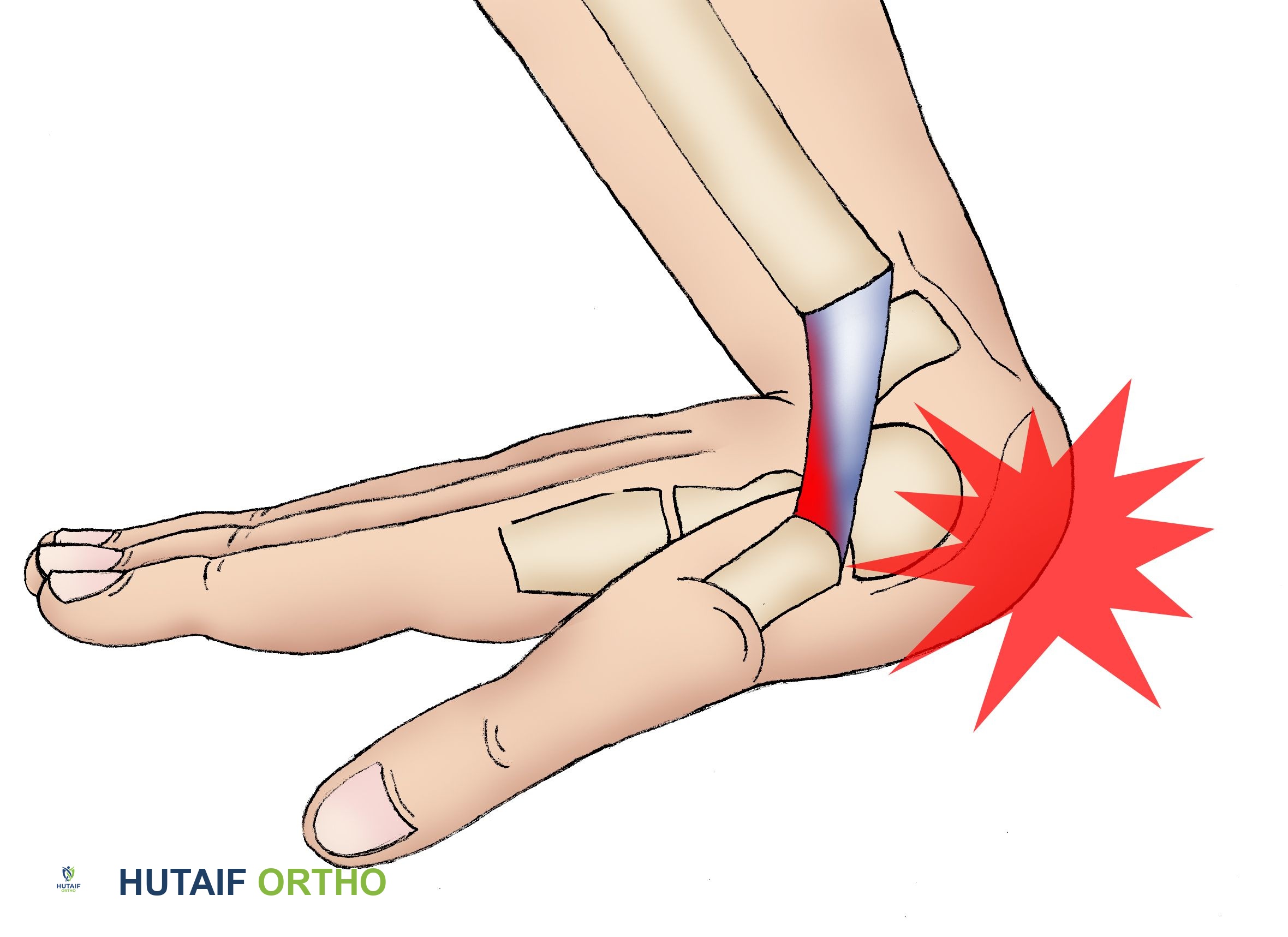 صورة توضيحية لـ التواء الرسغ: دليلك الشامل للتشخيص والعلاج والتعافي مع الأستاذ الدكتور محمد هطيف