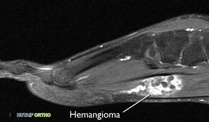 صورة بالرنين المغناطيسي لورم وعائي